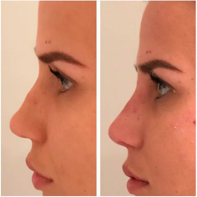 Refinamiento nasal - despues
